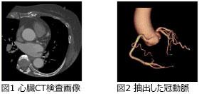 イメージ写真：心臓CT検査画像（図1）と冠動脈画像（図2）