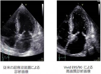 従来の超音波装置による診断画像／Vivid E95/90による高画質診断画像