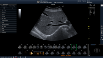LOGIQ S7 with XDclearによる診断画像